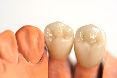 An image of a dental mold with two sets of teeth, one set appears to be natural and the other is an artificial denture.