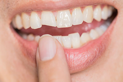 The image shows a close-up of a person's mouth with teeth, holding a finger in front of the teeth, and there is a visible gap between the teeth.