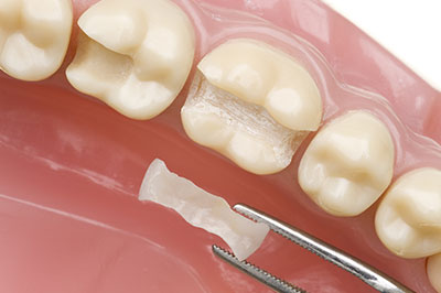 A dental prosthesis with a visible tooth filling material and a dental pick.