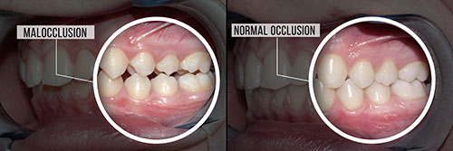 Dual images of a person's mouth with teeth, showcasing the before and after effects of a dental procedure.