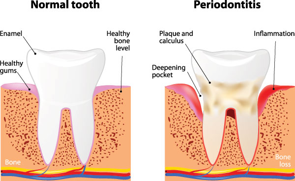 The image is a three-panel infographic illustrating the normal tooth structure, the progression of periodontitis with bone loss and gum pocket deepening, and the advanced stage of periodontitis showing severe bone loss and gum recession.