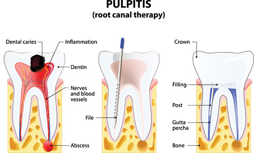 The image is a medical illustration showing the anatomy of a tooth with pulpitis, highlighting inflammation and infection around the pulp chamber.