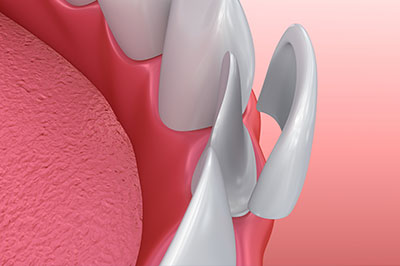 An image of a dental implant with a focus on the screw and abutment, set against a pink background.