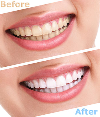The image displays a before-and-after comparison of dental whitening, showing a person with stained teeth on the left transitioning to a bright and clean smile on the right.