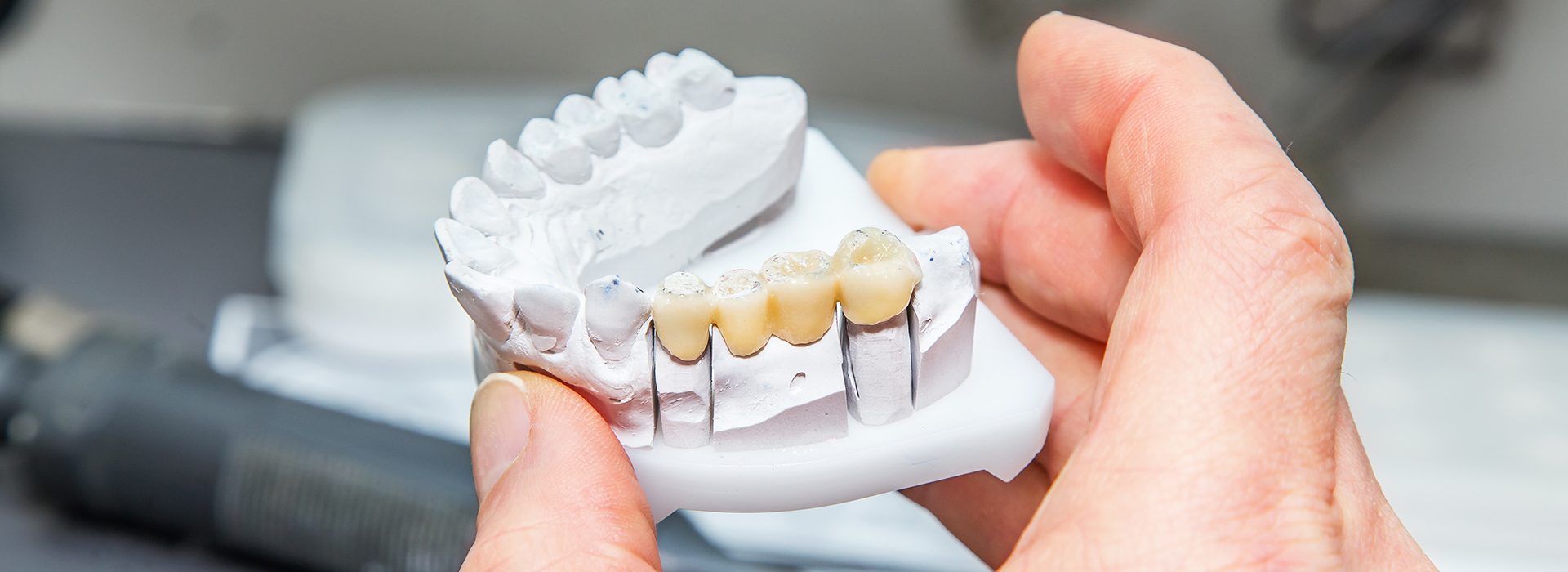The image shows a person holding a dental model with missing teeth, likely used for educational or demonstration purposes.