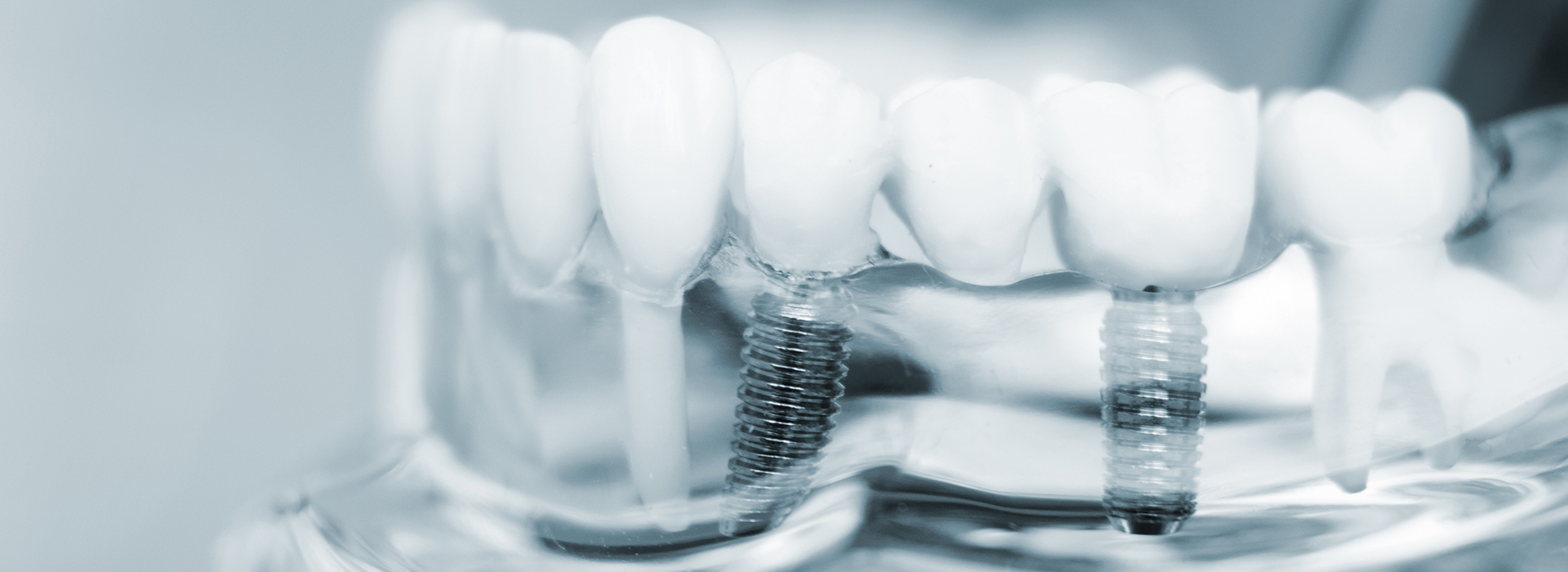 A close-up of a dental implant with screws, set against a blurred background.