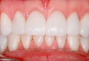 The image shows a close-up of a person's teeth with a focus on the upper front teeth, which appear to be a part of a dental implant or prosthetic, as indicated by the uniformity and artificial appearance of these teeth.