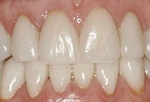 The image shows a close-up of a person's teeth with some discoloration, indicating the need for dental care or treatment.