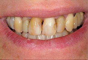 The image shows a person with a wide smile displaying yellowed teeth, some of which appear to have fillings or crowns.