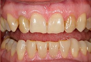 The image displays a close-up of a person's teeth with a focus on their yellowed and stained appearance.